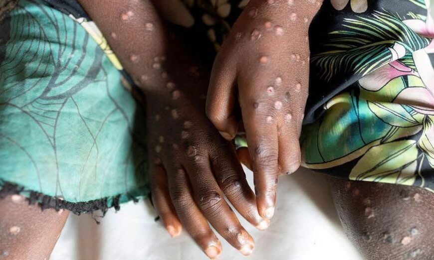 Ministério da Saúde Anuncia o Registo de Sete Casos da Varíola de Macacos (Mpox)